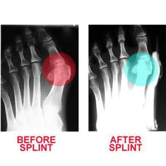 Bunion Corrector ( 1 Pair )